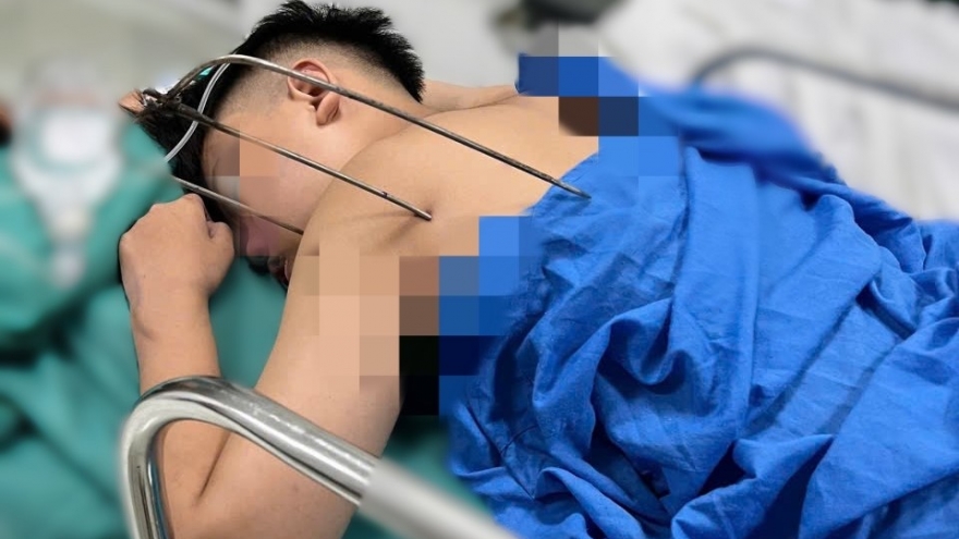 Cứu sống nam thanh niên bị dị vật kim loại tự chế xuyên thấu tim