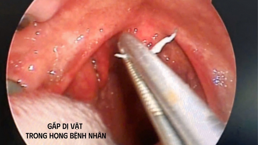 Cụ bà 79 tuổi mắc dị vật là sợi dây kim loại trong Amidan