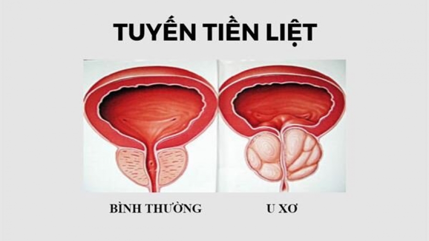 Kích thước tiền liệt tuyến bao nhiêu thì phải phẫu thuật?