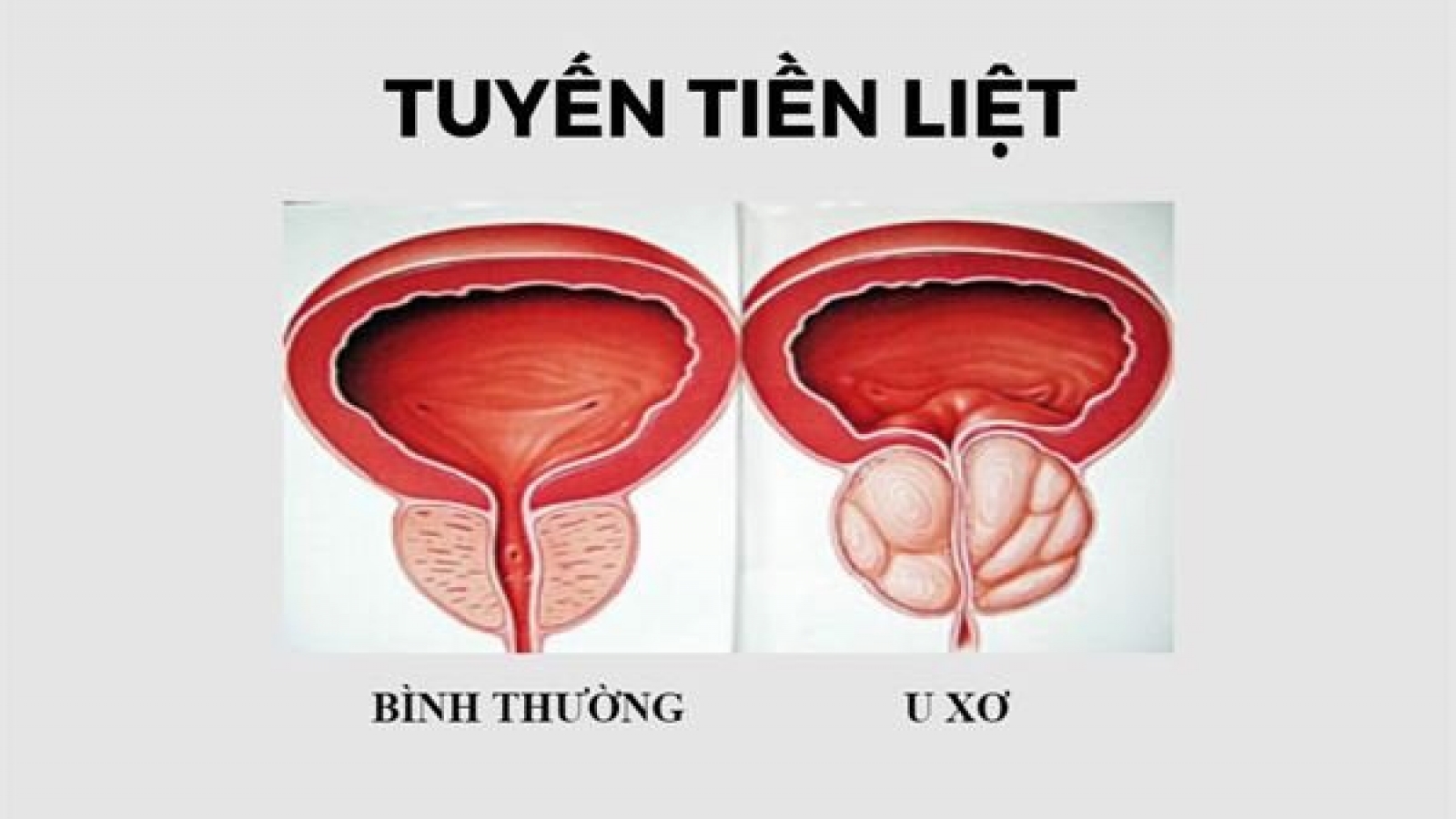 Kích thước tiền liệt tuyến bao nhiêu thì phải phẫu thuật?