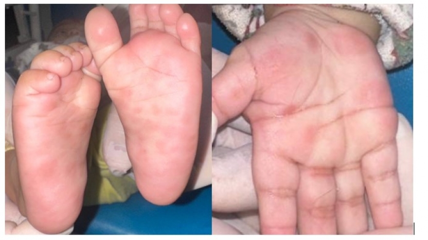 Bệnh nhi 4 tháng tuổi nhiễm giang mai do lây truyền từ mẹ