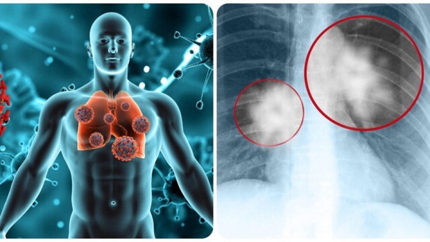 8 dấu hiệu cảnh báo ung thư phổi không nên bỏ qua