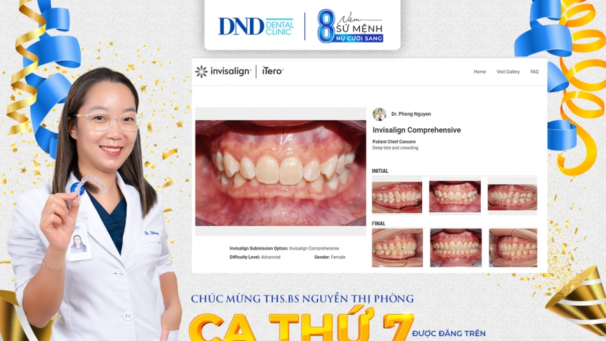 Niềng răng Invisalign - Không phải cứ chăm chỉ đeo khay niềng là răng sẽ đẹp