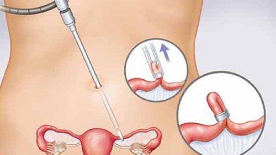 Phẫu thuật u nang buồng trứng bao lâu thì lành?