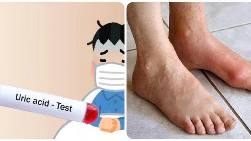 Axit uric là nguồn cơn gây ra nhiều bệnh nguy hiểm