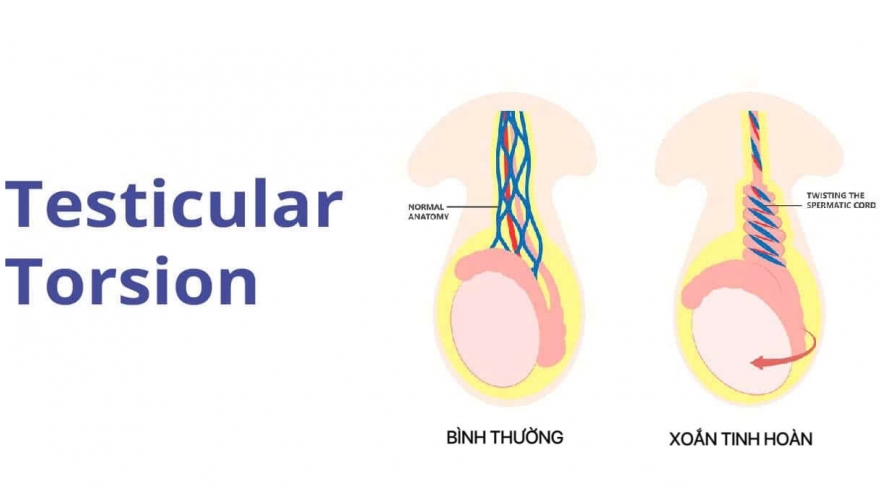 Cứu hai ca xoắn cơ quan sinh dục hiếm gặp, đe dọa khả năng sinh sản