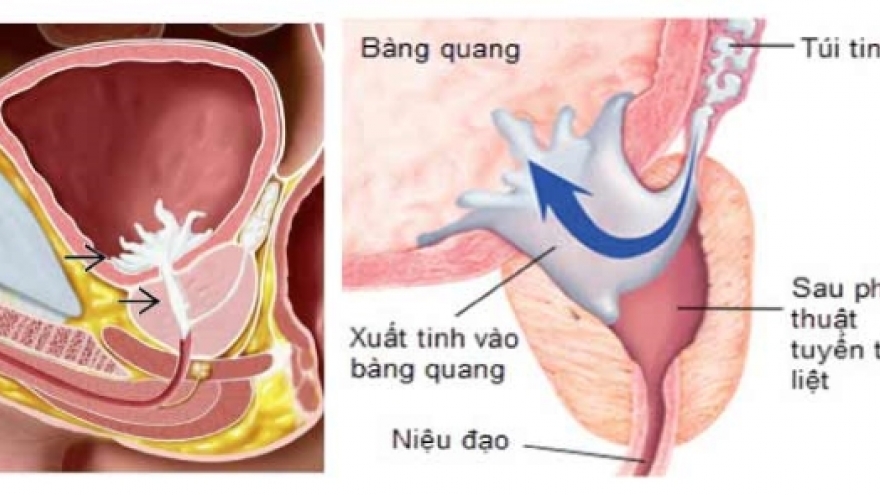 Xuất tinh ngược dòng ảnh hưởng ra sao đến khả năng có con?