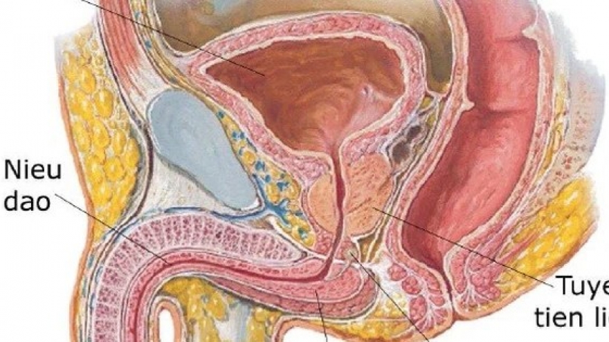 Nút mạch tuyến tiền liệt có chữa trị được dứt điểm và giá cả điều trị?