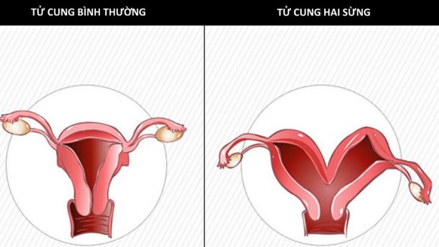 Tử cung hai sừng liệu có thể mang thai tự nhiên được không?