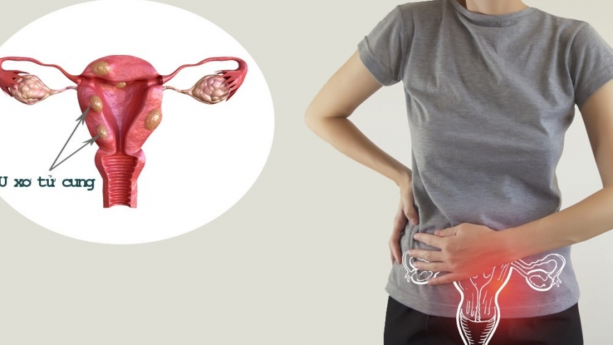 U xơ tử cung ảnh hưởng tới quá trình mang thai thế nào?