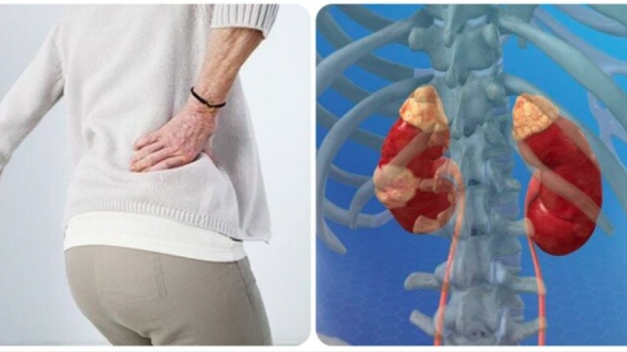 Triệu chứng ung thư thận giai đoạn cuối