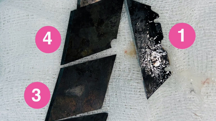 Cứu sống nam thanh niên nuốt 4 lưỡi dao rọc giấy và 1 dao lam vào bụng