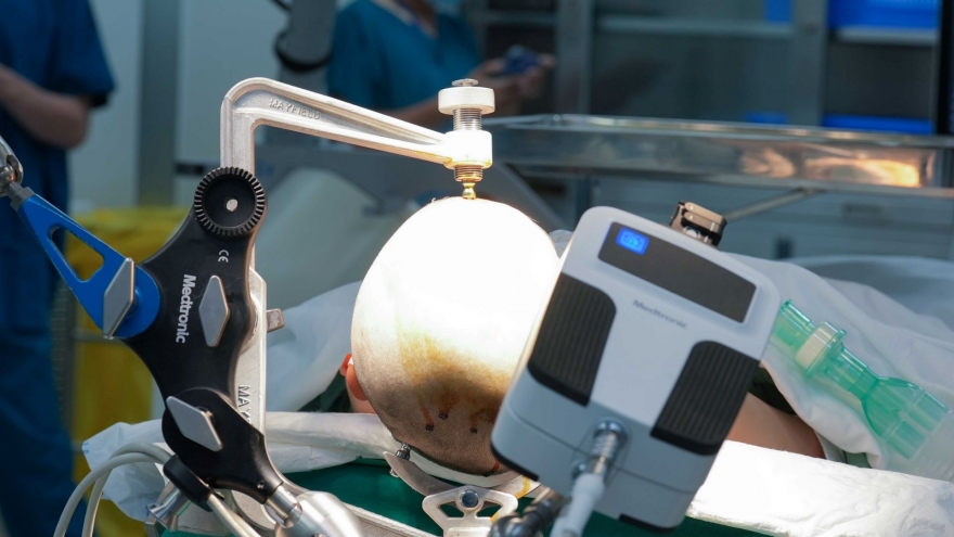 Vinmec tiên phong điều trị động kinh bằng Robot định vị thần kinh hàng đầu thế giới