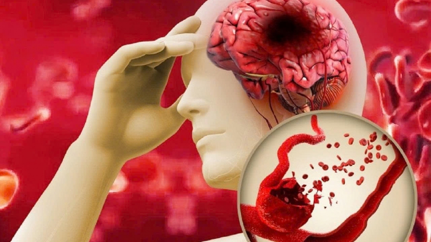 Nguy hiểm từ mẹo chữa đột quỵ bằng kim chích đầu ngón tay lan truyền trên mạng