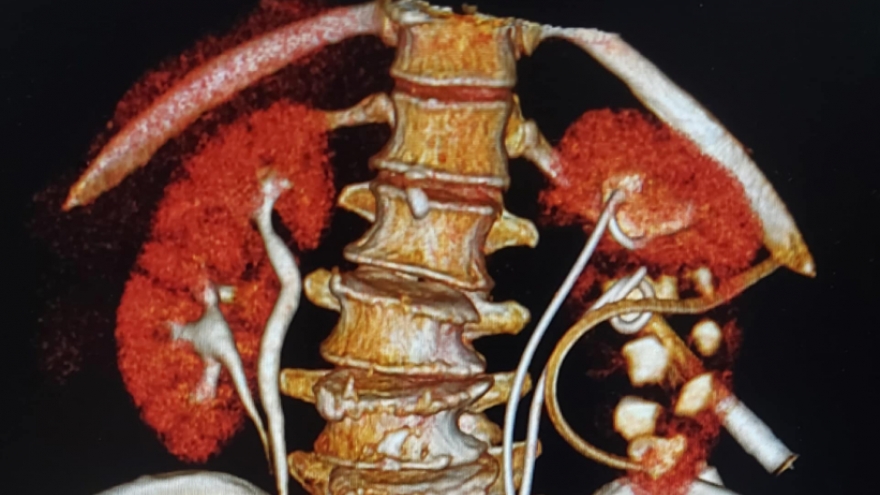 Từ TPHCM ra Hà Nội khám bệnh, người phụ nữ phát hiện có 4 quả thận