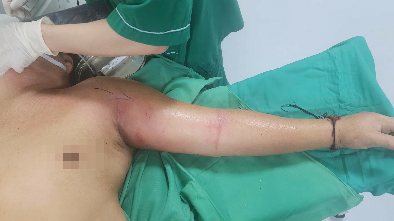 Nhiễm trùng nặng vì tự tiêm mật gấu vào tay để chữa đau ngực