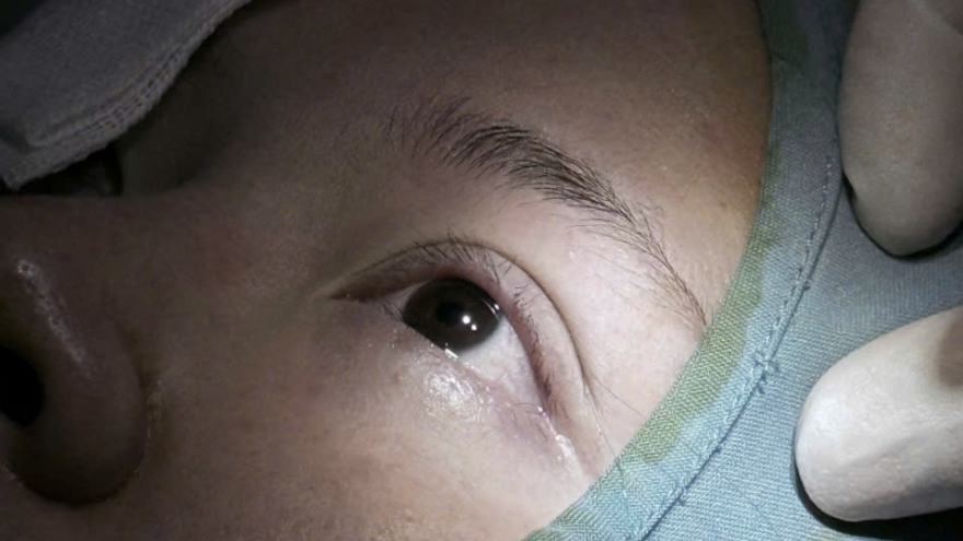 Ths.Bs Hồ Cao Vũ điều trị nhấn mí hỏng