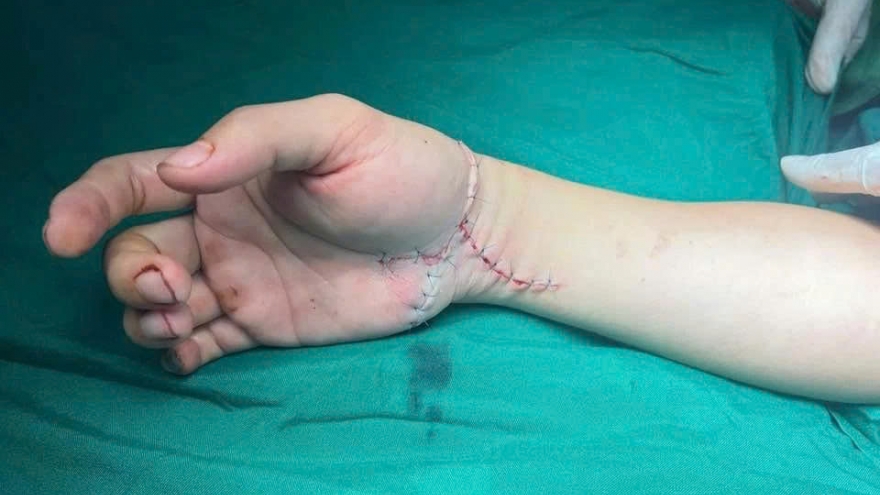 Cứu đôi tay Tiktoker ở Thái Nguyên qua lời kể của bác sĩ
