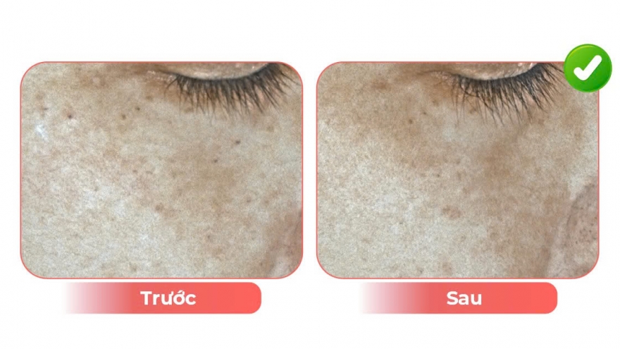 Edopi Clinic - Trẻ hóa da Led pure light được phụ nữ tuổi 40-50 yêu thích