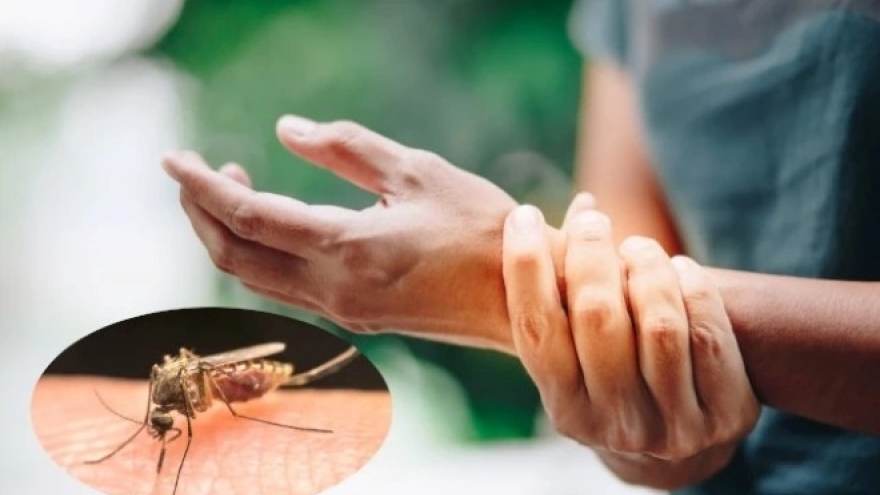 Chikungunya dễ bị nhầm với bệnh khác, nhớ 2 dấu hiệu đặc trưng này để phân biệt