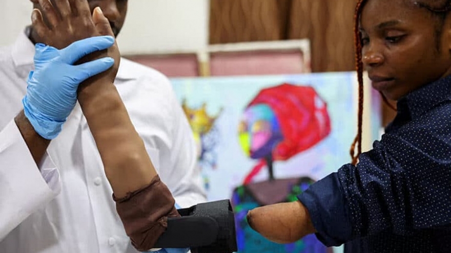 Nigeria ra mắt cánh tay sinh học, Australia nuôi cấy thành công da người