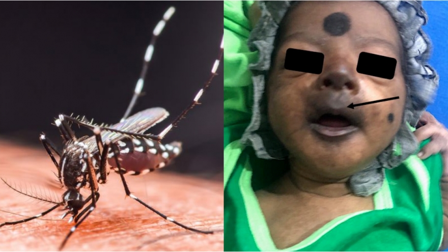 Chikungunya từng khiến bé sơ sinh mặt tím đen, phải nhập viện cấp cứu khẩn cấp