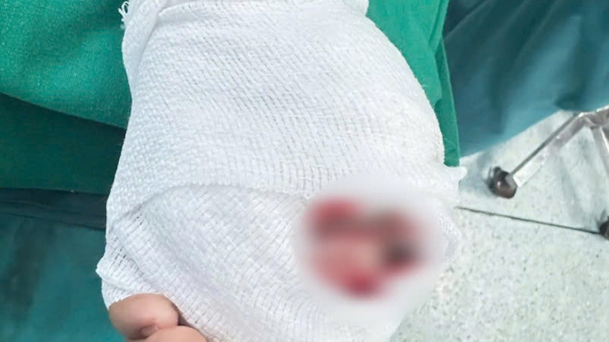 Nối lại ngón tay bị đứt gần lìa cho bé trai 5 tuổi nhờ kỹ thuật vi phẫu