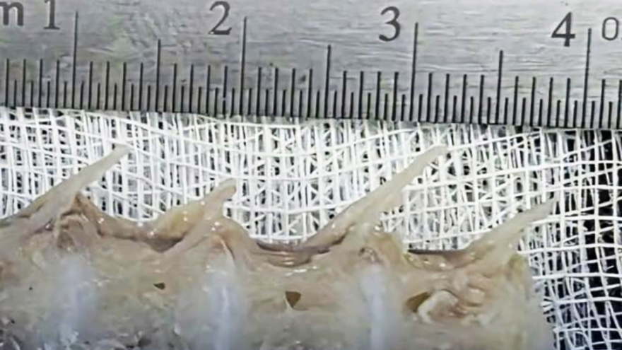 Cụ ông gần 100 tuổi bị hóc xương cá lớn ở Quảng Trị được cấp cứu kịp thời