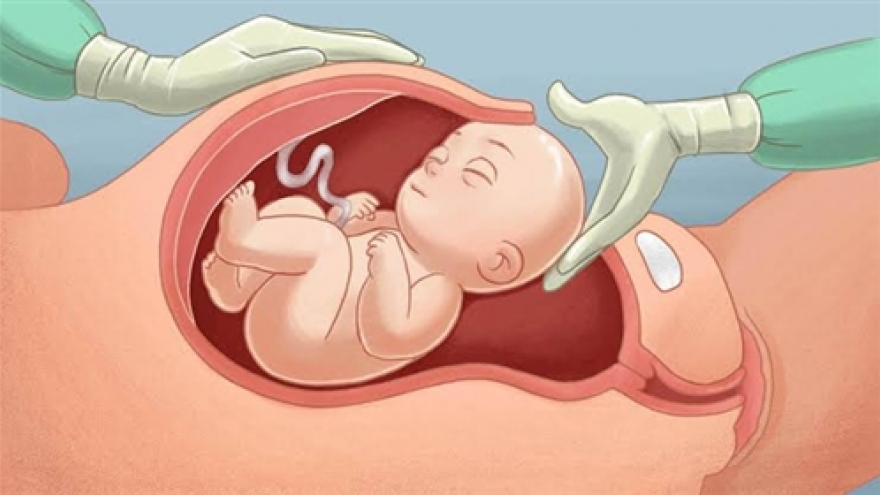 Đừng để “giờ đẹp, ngày đẹp” thành rủi ro cho trẻ sơ sinh