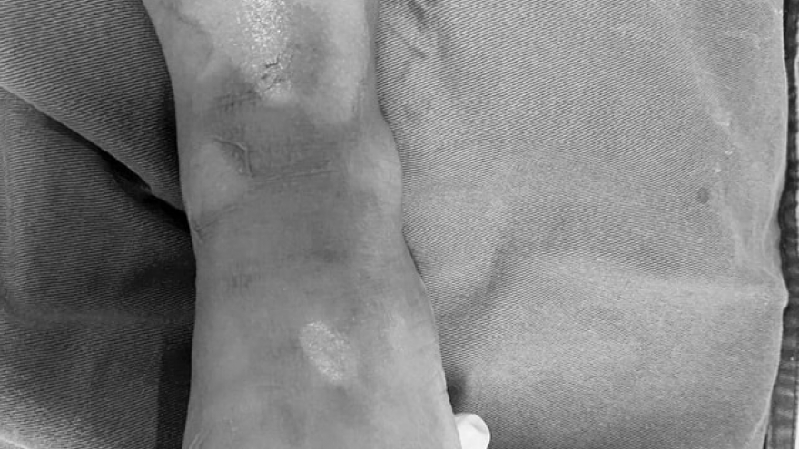 3 trẻ nhỏ bỏng nặng do tai nạn khi ăn lẩu cùng gia đình