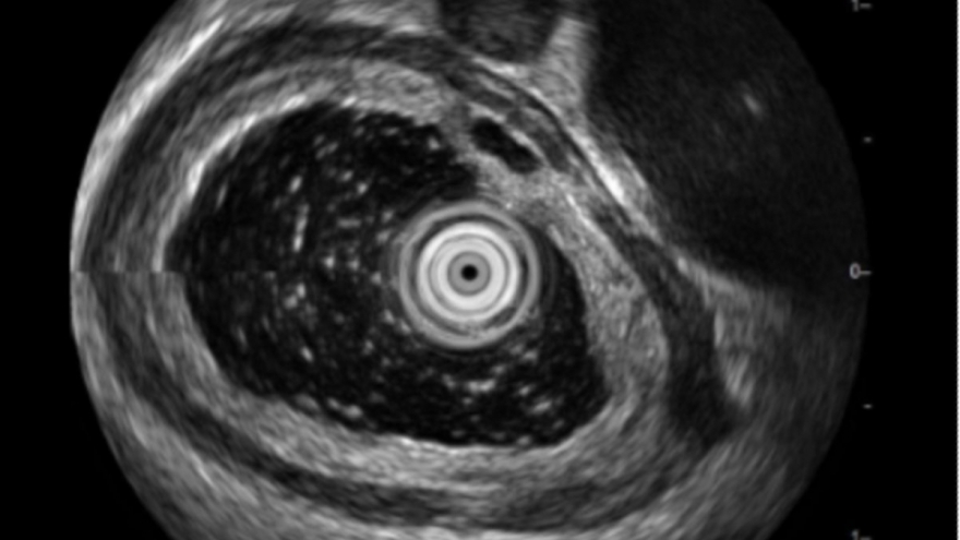 Biểu hiện bất thường sau khi uống bia, có thể mắc bệnh nguy hiểm