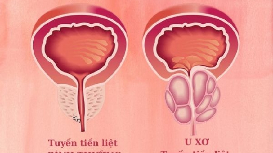 Tiền liệt tuyến hơn 60g, uống thuốc có thể tiêu hết hay không?