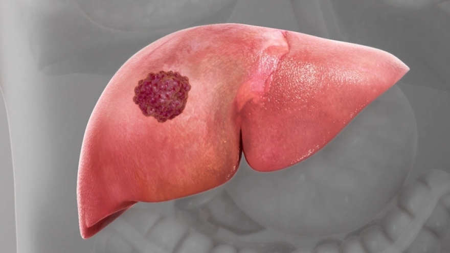 Loại ung thư gây tử vong hàng đầu tại Việt Nam liệu có chữa khỏi?