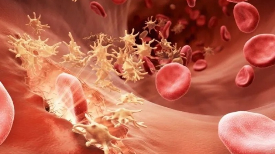 Con dâu tôi bị bệnh rối loạn đông máu và đã 2 lần bị sảy thai