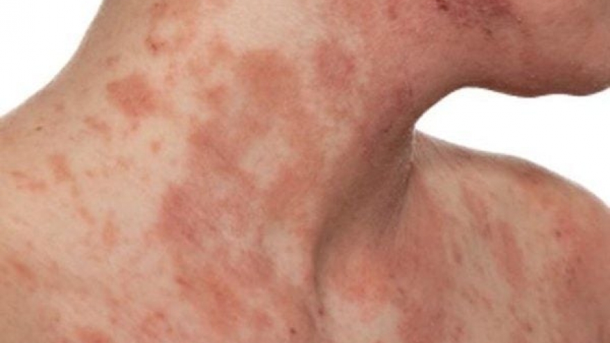 Viêm da cơ địa nhiều năm liệu có thể điều trị dứt điểm?