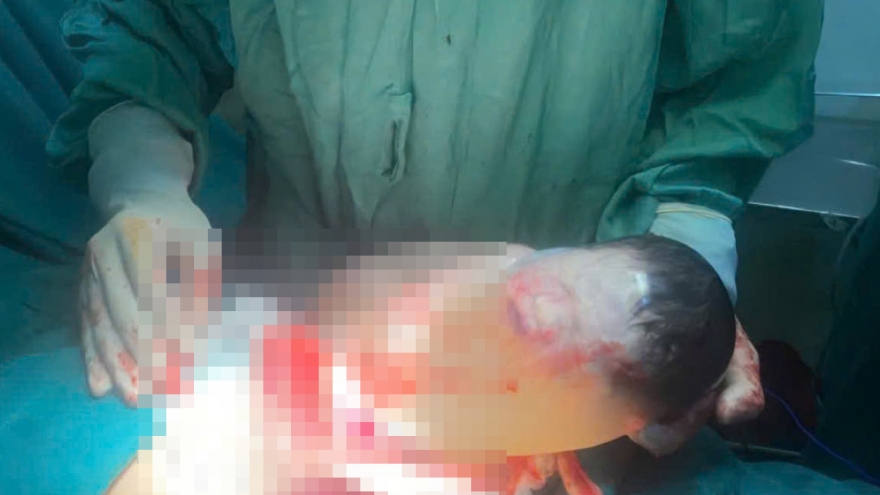 Kỳ diệu: Bé sơ sinh chào đời trong bọc ối còn nguyên