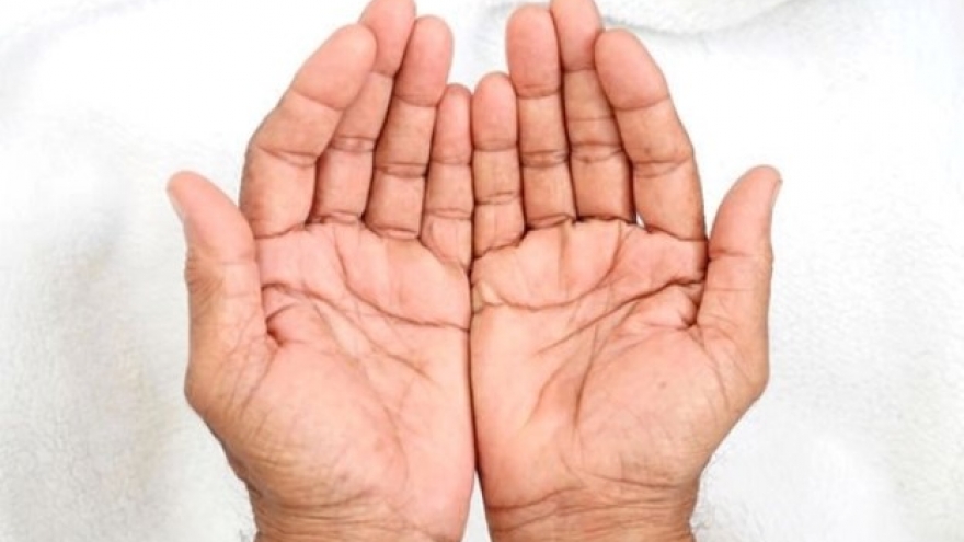Người có gan suy yếu thường có những dấu hiệu này ở bàn tay nhưng ít được chú ý