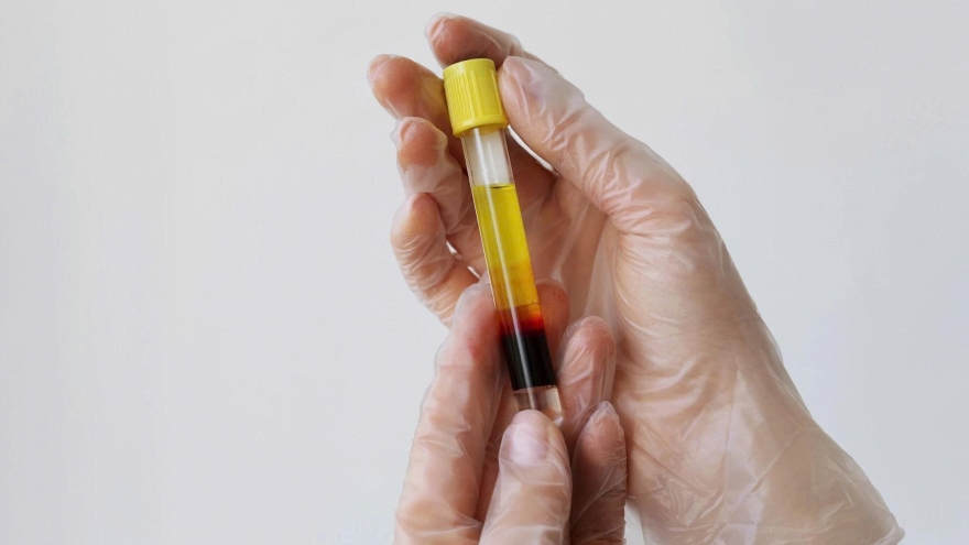 Người trẻ đối mặt “sát thủ thầm lặng” mang tên mỡ máu