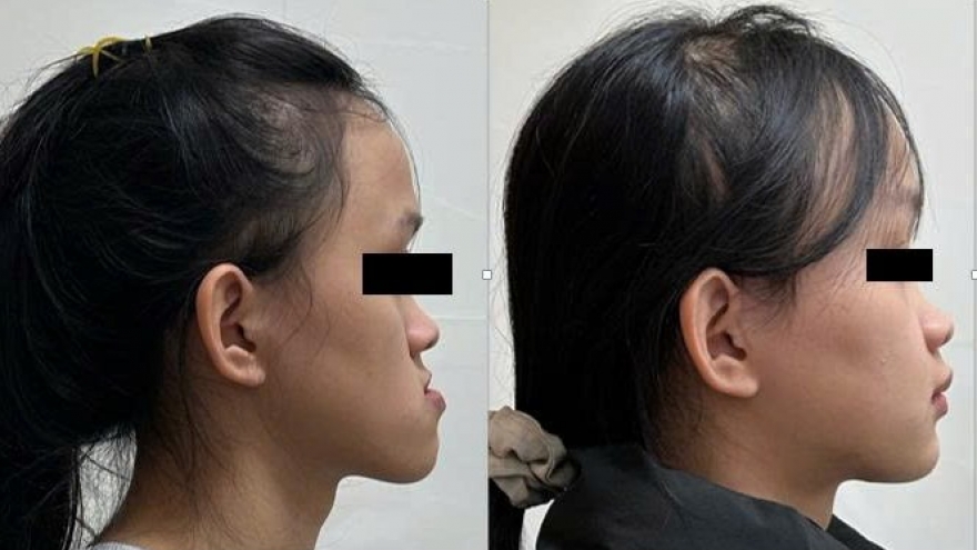 Điều trị móm (khớp cắn ngược) do xương hàm