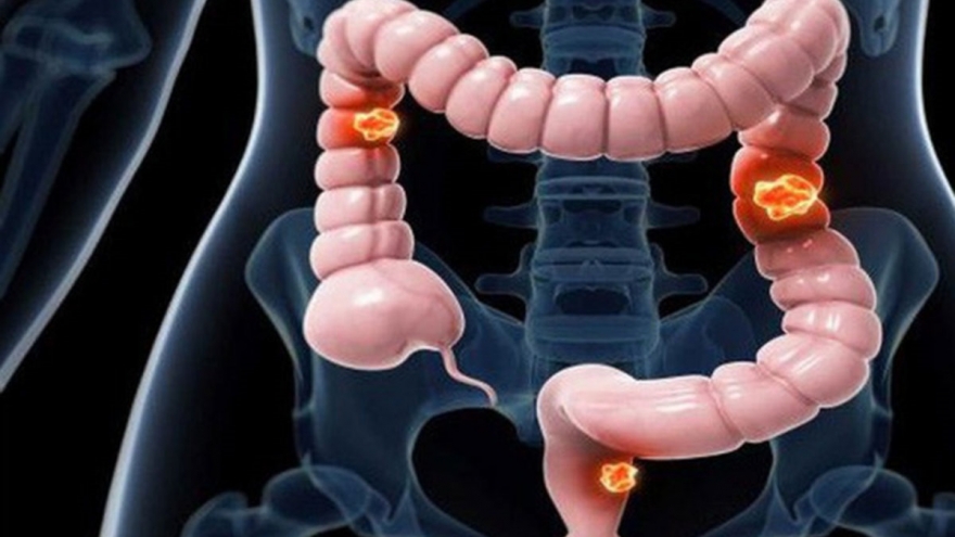 Có nên sử dụng thuốc nam và hóa chất cùng lúc sau phẫu thuật u trực tràng?