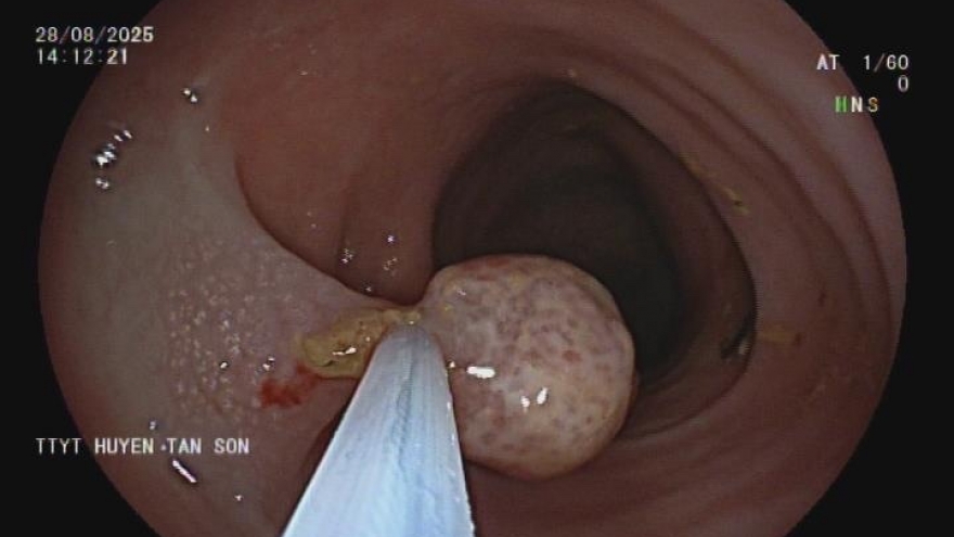 Hiếm gặp: Bệnh nhi 9 tuổi phát hiện 4 polyp trực tràng