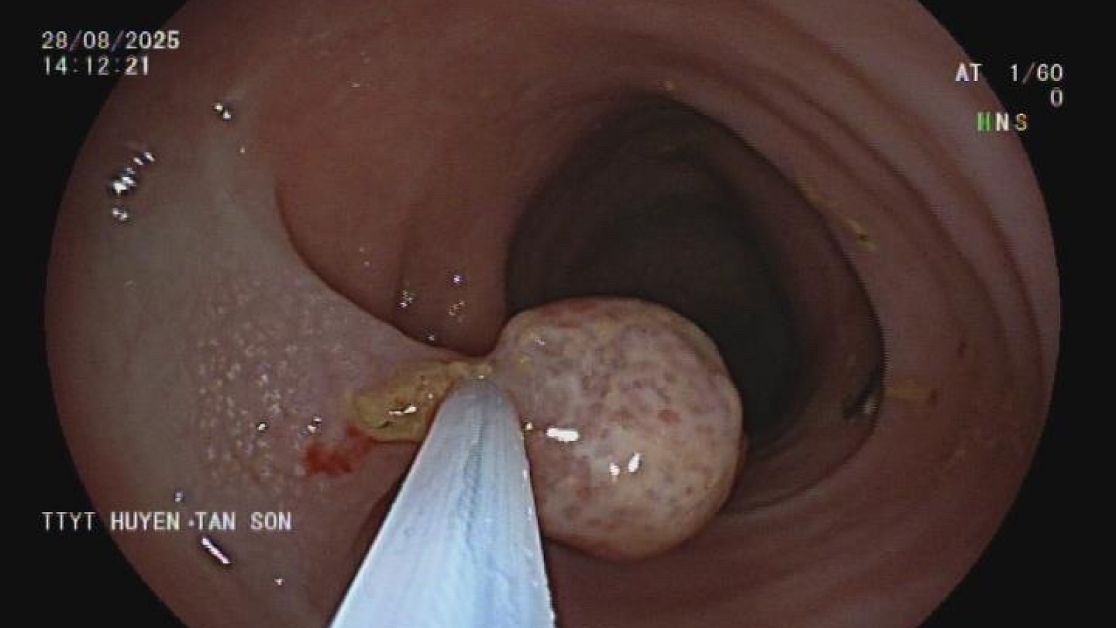 Hiếm gặp: Bệnh nhi 9 tuổi phát hiện 4 polyp trực tràng