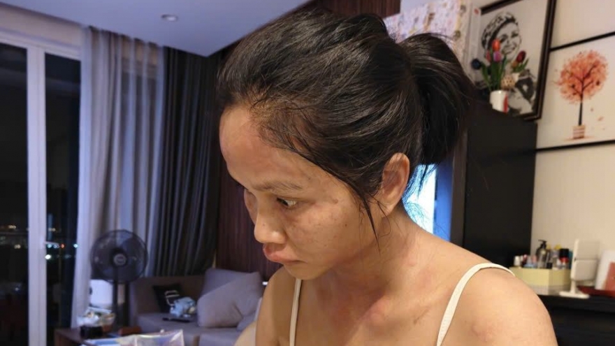 Sao Việt 24/10: Hoa hậu H'Hen Niê bị nổi mề đay sau sinh