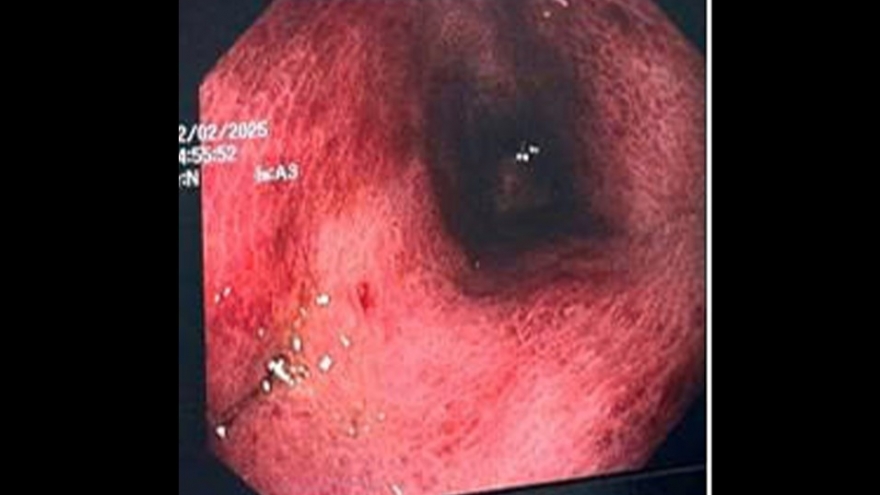 Vi khuẩn lạ khiến người đàn ông suýt hoại tử toàn bộ dạ dày
