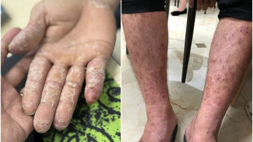 Những bệnh về da thường gặp sau mưa lũ