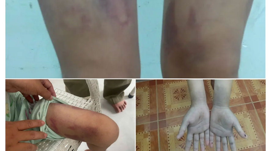 Đang giám định thương tích bé gái 9 tuổi ở TP.HCM bị mẹ ruột và bạn trai bạo hành