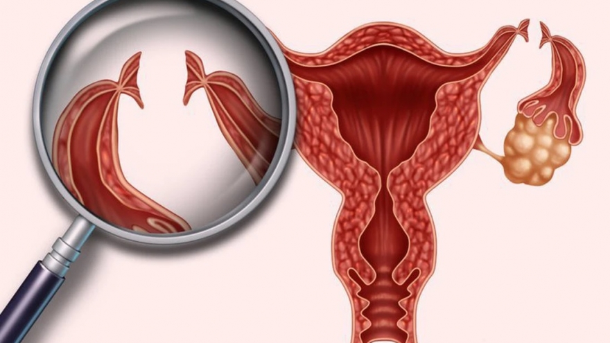 Sau khi cắt một bên vòi trứng, khả năng sinh sản bị ảnh hưởng ra sao?