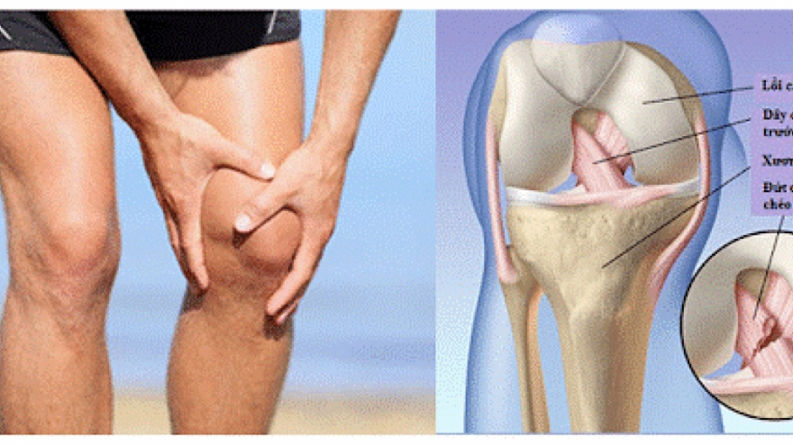 Xử trí thế nào khi bị chấn thương dây chằng khớp gối?