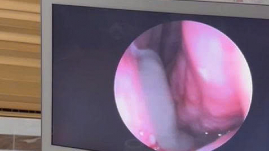 Bác sĩ gắp con đỉa sống trong mũi người đàn ông ở Phú Thọ