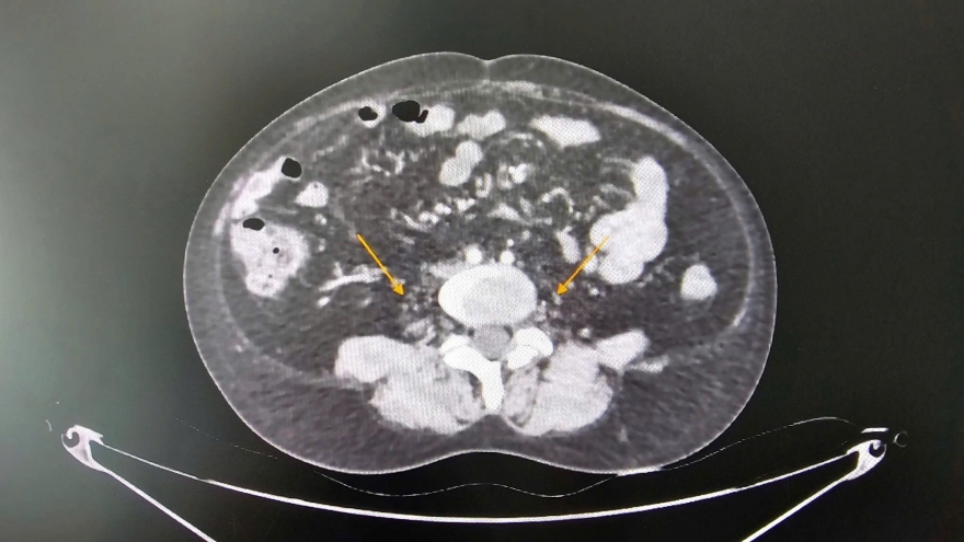 Hiếm gặp: Hội chứng “bụng quả mận khô”